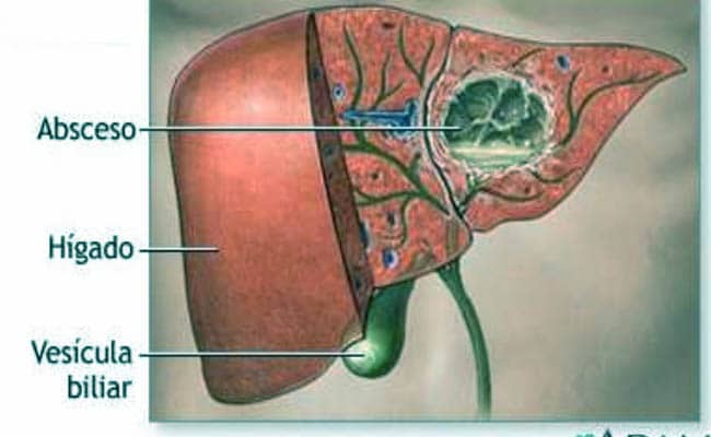 el absceso hepático y todo lo que debes saber de su tratamiento