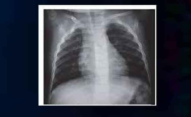 cual es el tratamiento para la neumatocele